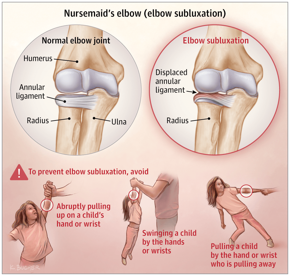 Nursemaid's Elbow Diagram 