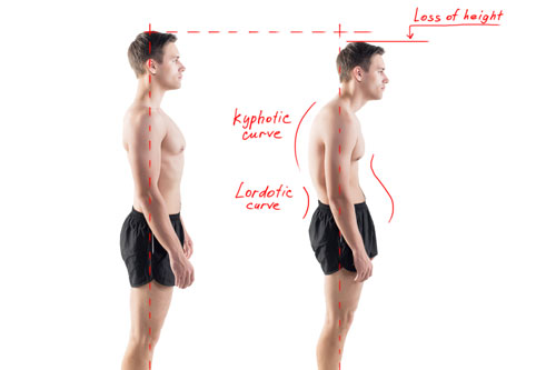 Rounded Upper Back Kyphosis