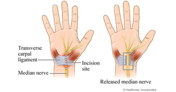 Carpal Tunnel Syndrome Surgery